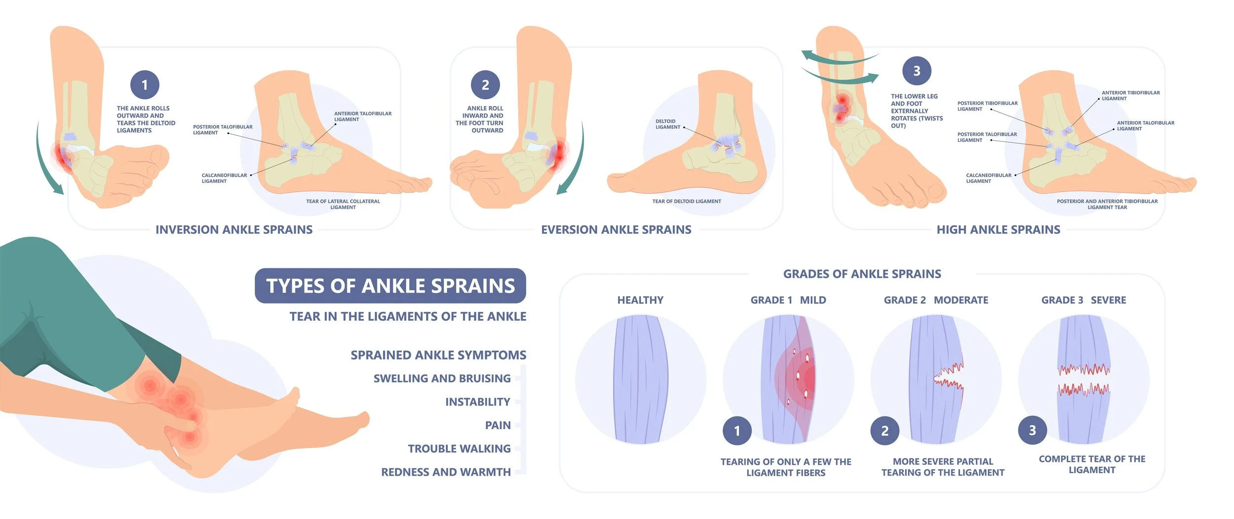 STS First Aid guide to treating sprains STS First Aid